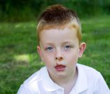 School sores - Impetigo