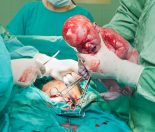 Caesarean section – the first few days