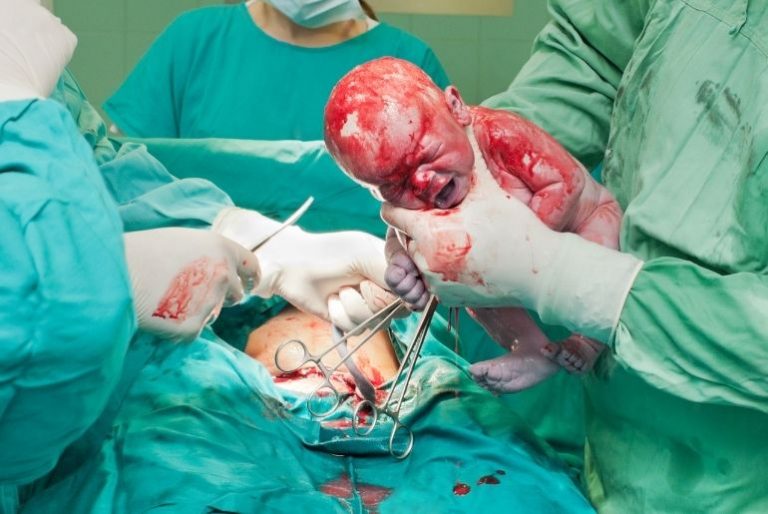 Caesarean section – the first few days