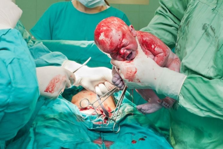 Caesarean section – the first few days Caesarean section – the first few days