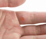how to get rid warts