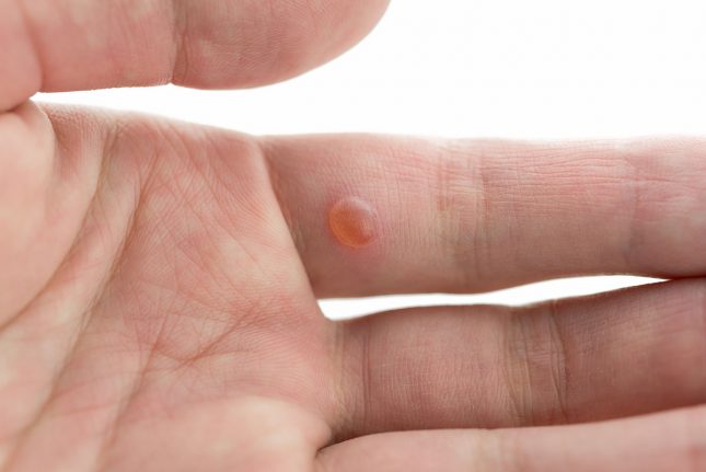 how to get rid warts