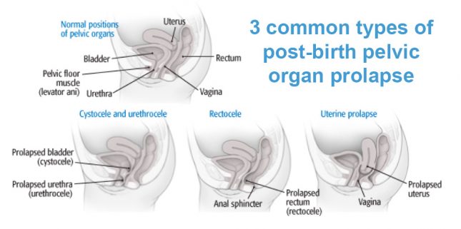 post birth pelvic organ prolapse