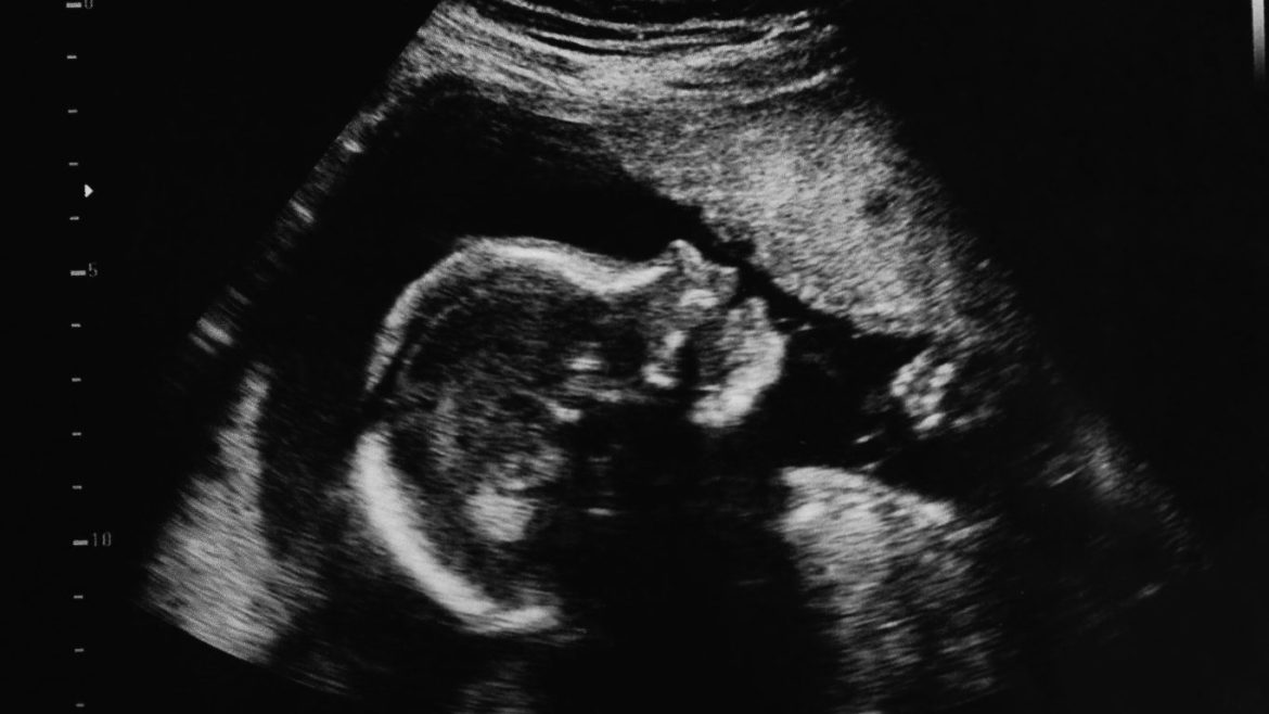 Recent Study Identifies Possible Connection to Autism